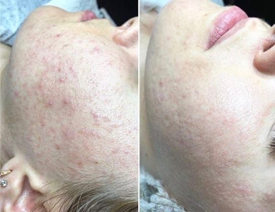 Чистка лица+пилинг по типу кожи.