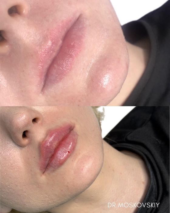 Увеличение губ|Алмата АКЦИЯ