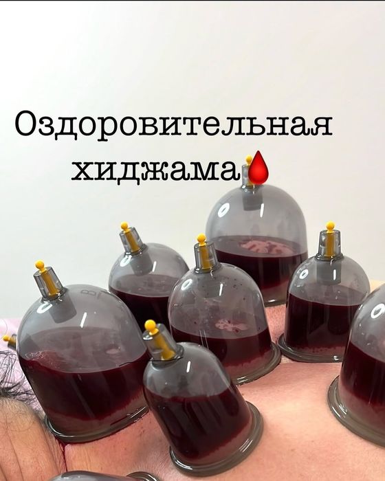 Хиджама Капиляротеропия