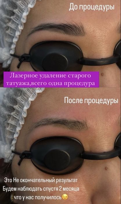 Лазерное удаление татуажа 5000