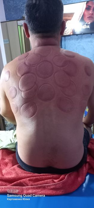 Аль Хиджама Лечебная