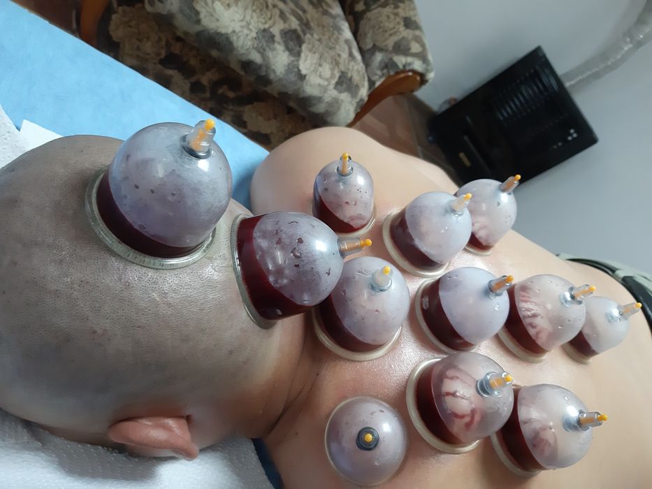 хиджама лечение по сунне.