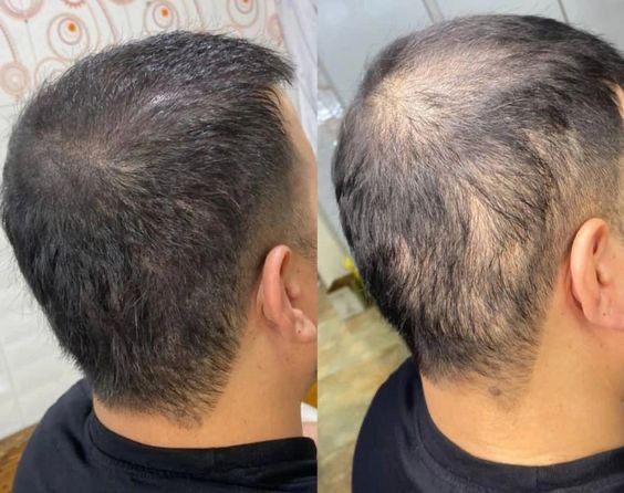 Soch tushishi yoki alopesiya bilan qiynalayapsizmi?Shifokor dermatolog