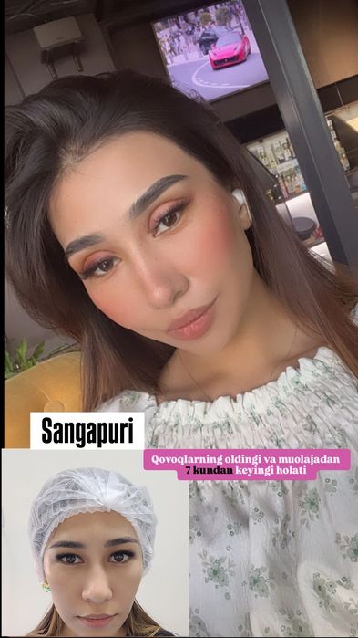 -50% CHEGIRMADA Blefaroplastika