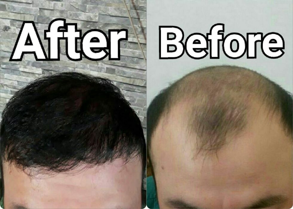 Soch Ekish. Peresadka Volos clinic 20 yil