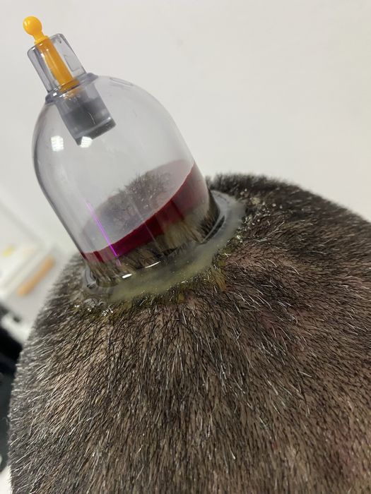 Хиджама лечнбно оздоровление