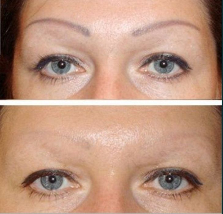 Удаление старого татуажа ремувером