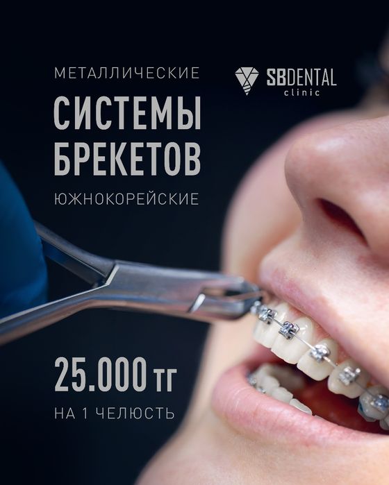 Брекеты установка