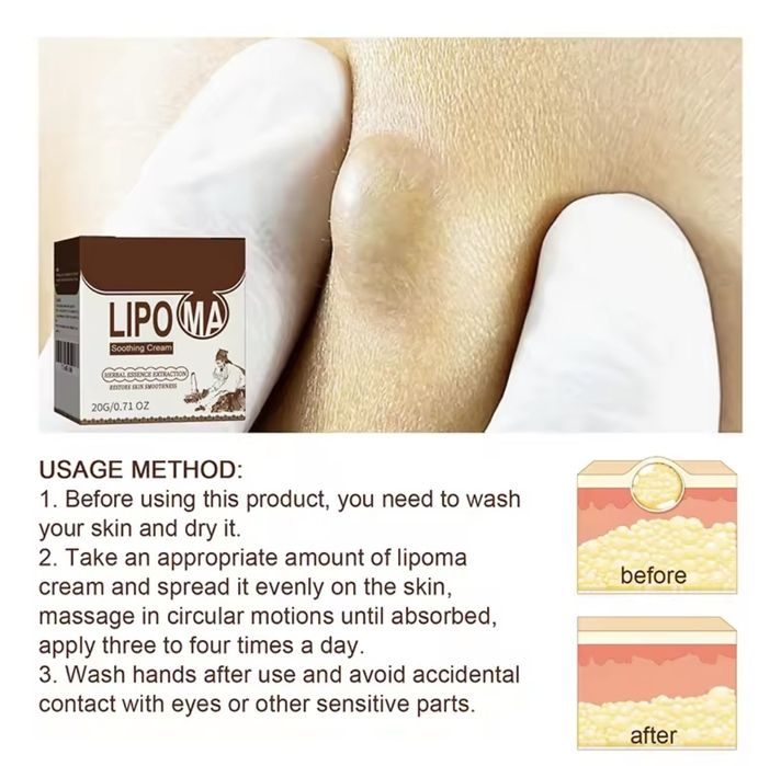 Мехлем против липоми