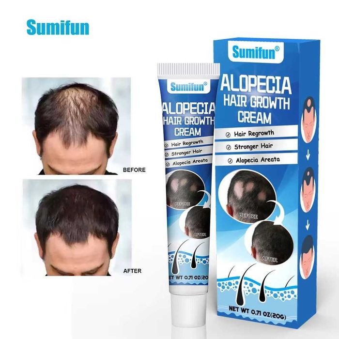 крем против алопеция