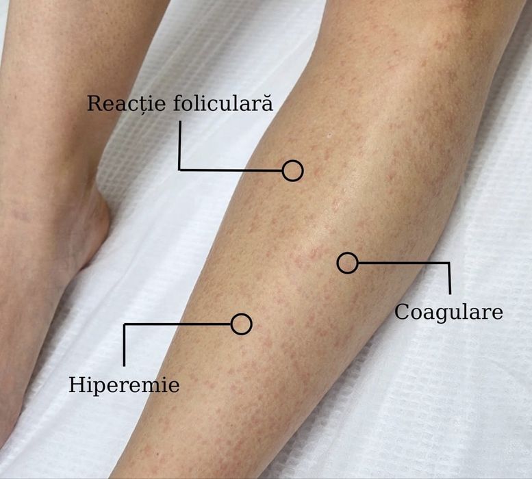 Epilare definitva sect 2