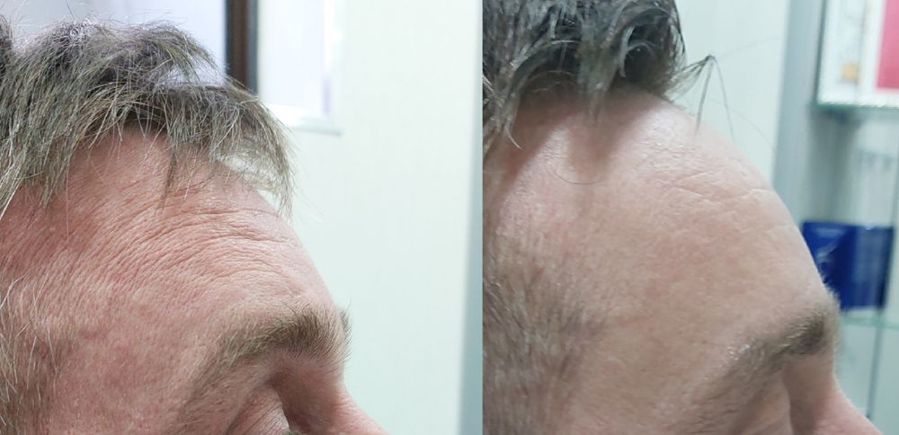 Ботулинотерапия. Лечение морщин ( ботокс)