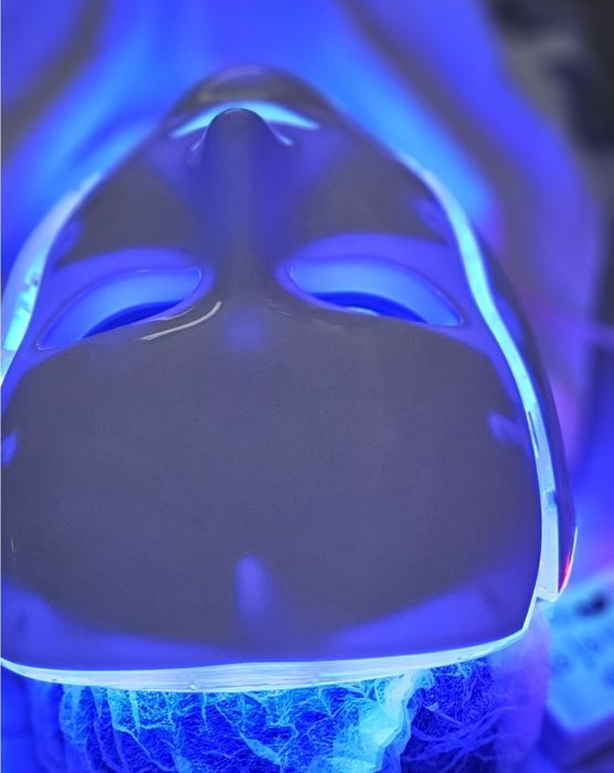 Радиочестотен лифтинг за лице и тяло