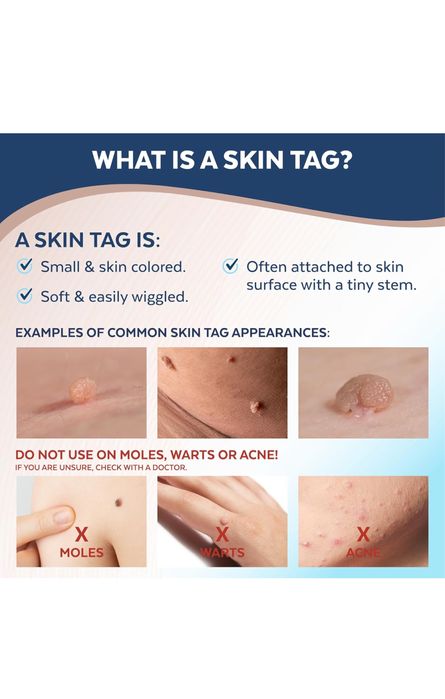 Dispozitiv de îndepărtare a etichetelor cutanate