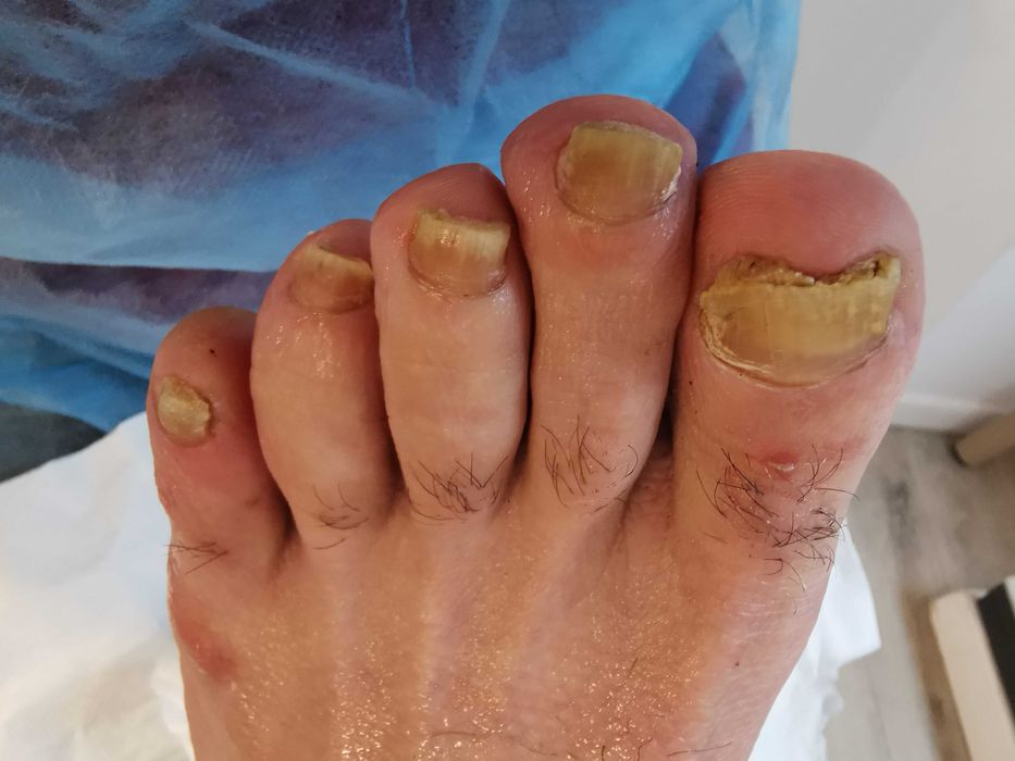 Cabinet pedichiura complexa /onicomicoze /unghii încarnate Alb