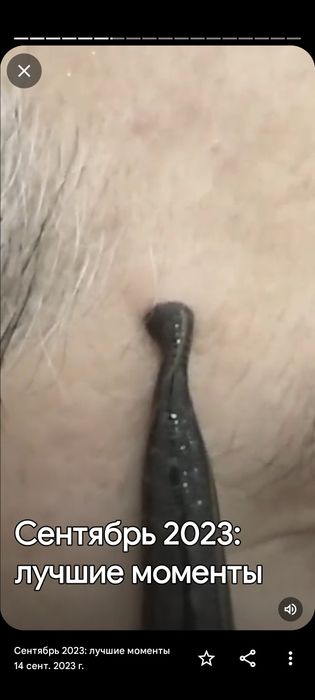 тиббий зулуклар гирудотерапия