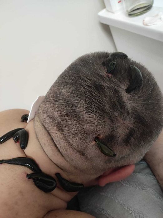 Хиджама Астана кровопускание