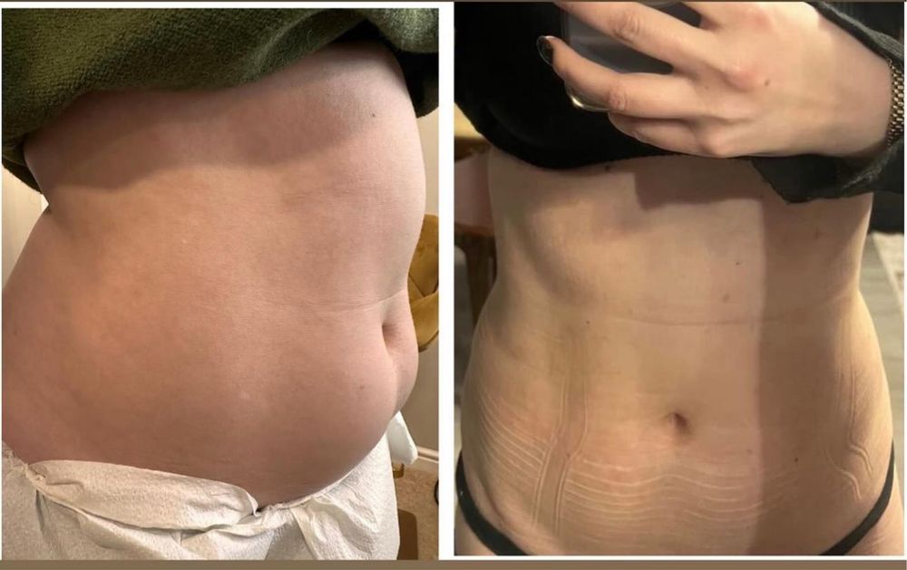 Lipoliză Injectabilă Fără Ac
