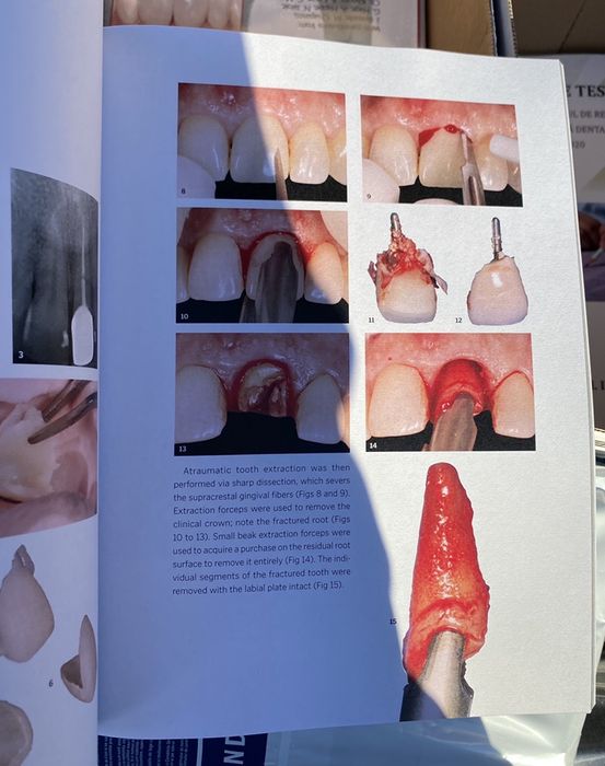 The Single-Tooth Implant J.Chu