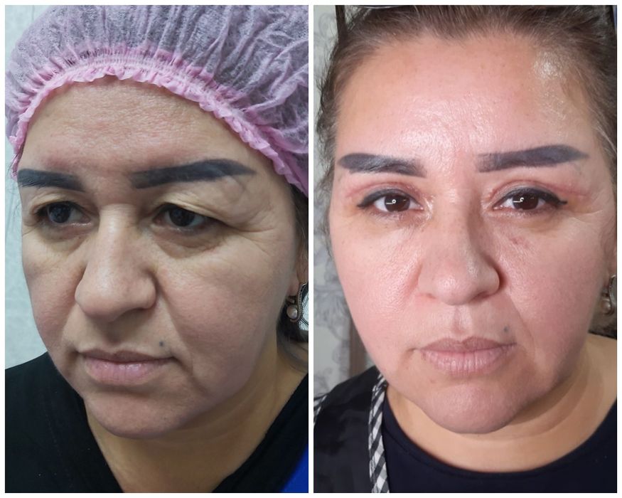 Косметолог блефаропластика,Броулифтинг.Лабиопластика.