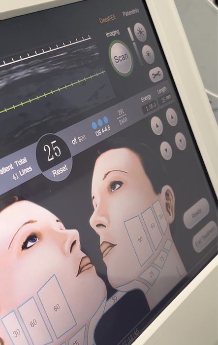 Ulthera HIFU featuring deep see