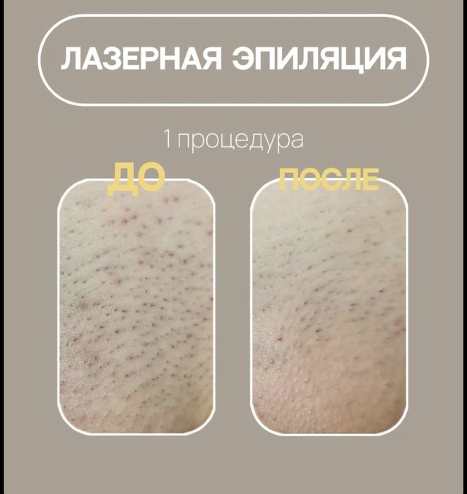 Лазерная эпиляция по выгодным ценам скидки на все зоны