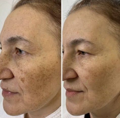 Yuzga meza terapiya,  Косметолог,  меза терапия лица и шеи 1+1