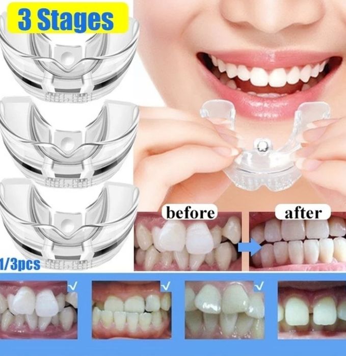 Промо-Ортодонтски коректор,шини,алайнер на зъби брекети зъбен фиксатор