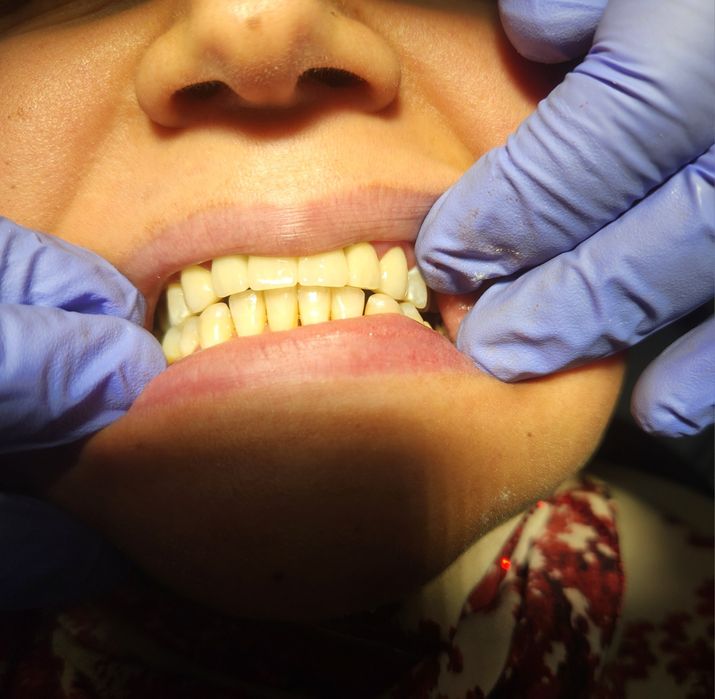 Tish og'riyaptimi? Bugun qabul | Chilonzor - stomatolog | Болит зуб?