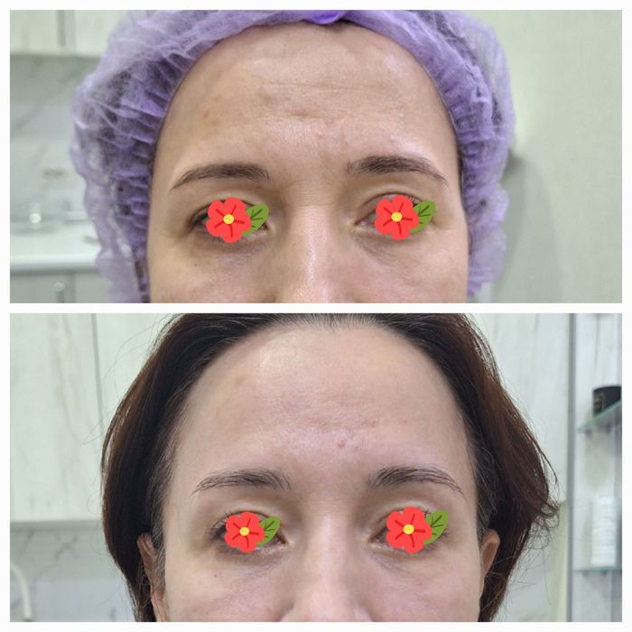 Ботулинотерапия. Лечение морщин ( ботокс)