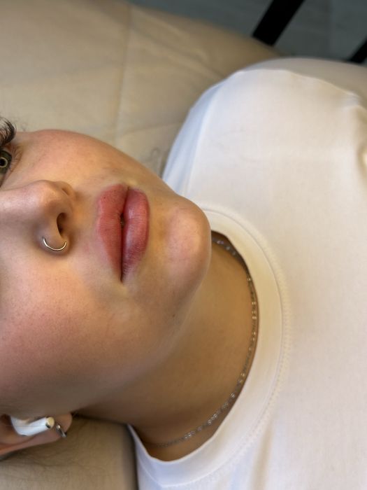 Контурная пластика губ