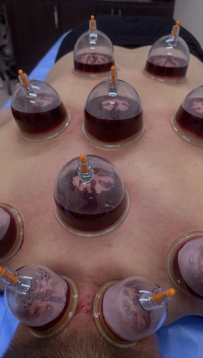 Хиджама, Пиявки Массаж емдері