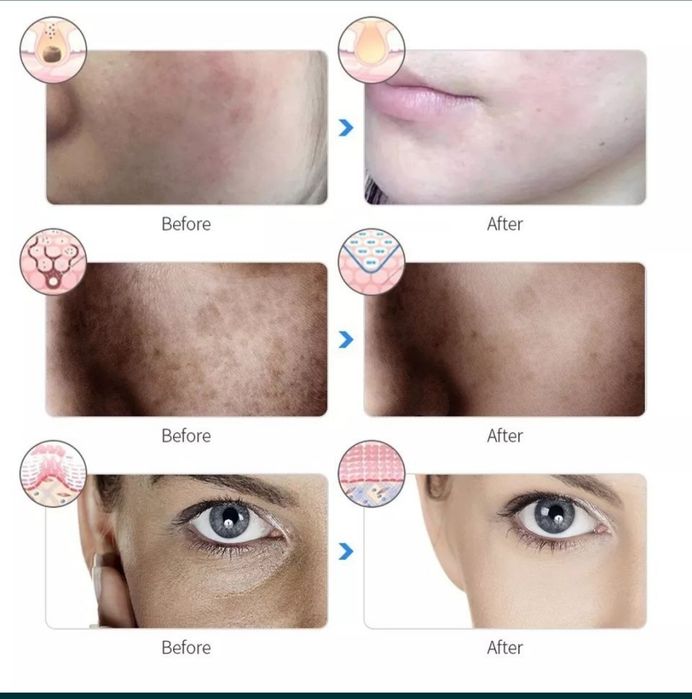 Всетодиодная LED маска для лица творит настоящие чудеса с кожей лица.