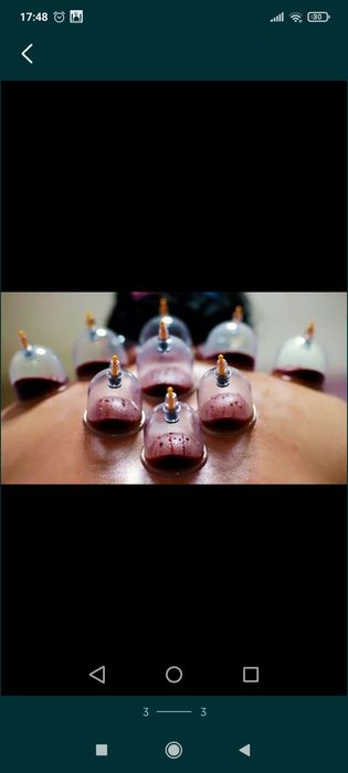 Хиджама кровопускание