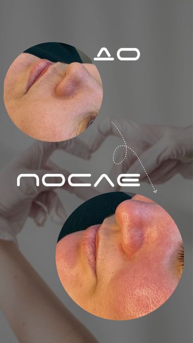 Контурная пластика губ