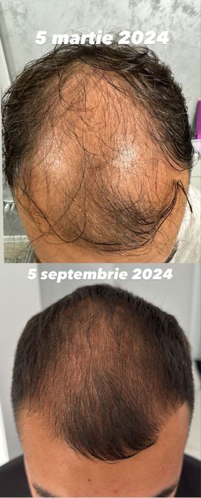 Tratament pentru cresterea parului