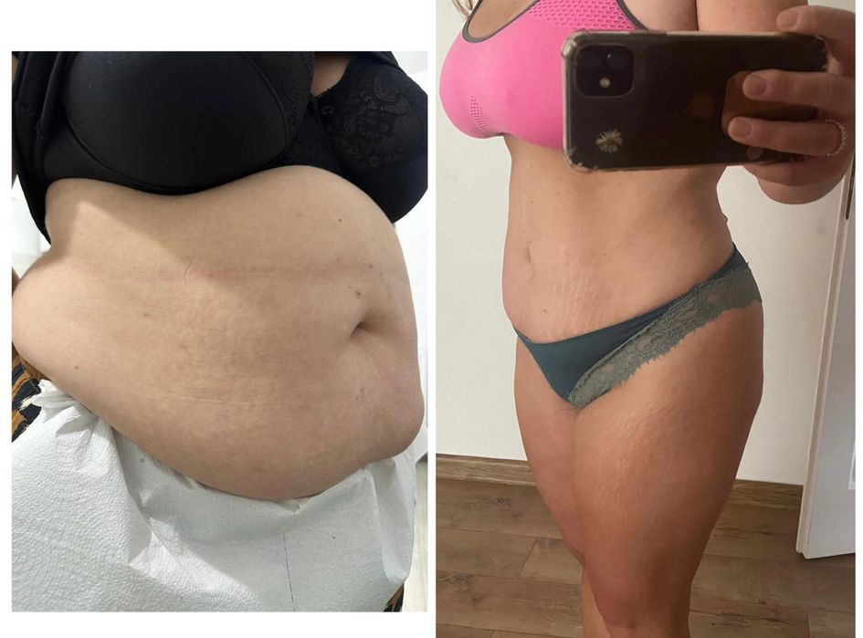 Lipoliză Injectabilă Fără Ac