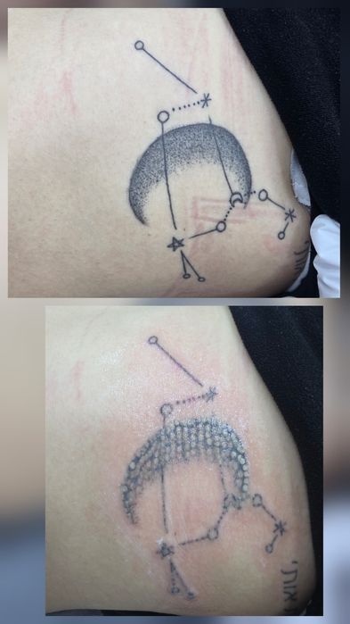 Удаление татуировок любой сложности от 200 тысяч сум