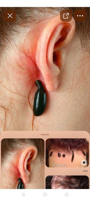 Пиявки. Гирудотерапия.