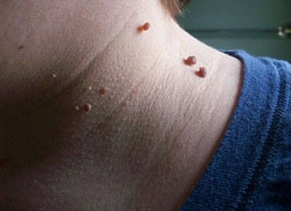 Удаление папиллом . Косметолог.