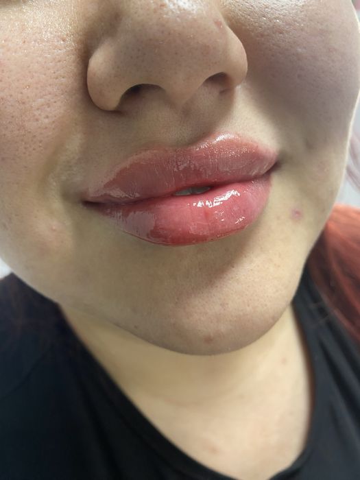 Акция Увеличение Губ