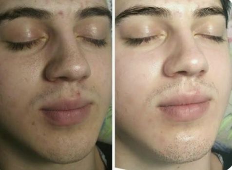 Yuzni chishtka qilish. Глубокая чистка лица