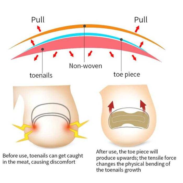 10 самозалепващи се стикери за нокти, без нужда от лепило. Лесни за поставяне и премахване. Декорация на Нокти Врастнали Нокти на Краката ПАРОНИХИЯ