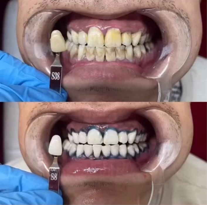 Продаеться бизнес отбеливание зубов