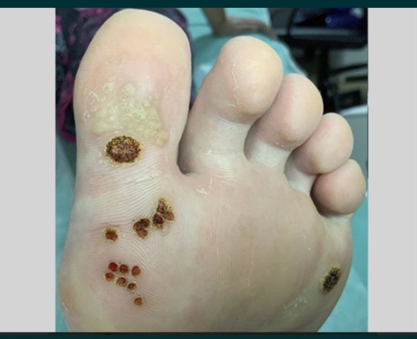 Удаление бородавок, папиллом, лазером. Лазерное удаление