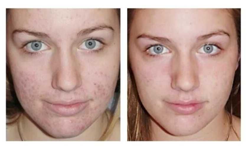 Чистка лица, Yuz tozalash, косметолог.