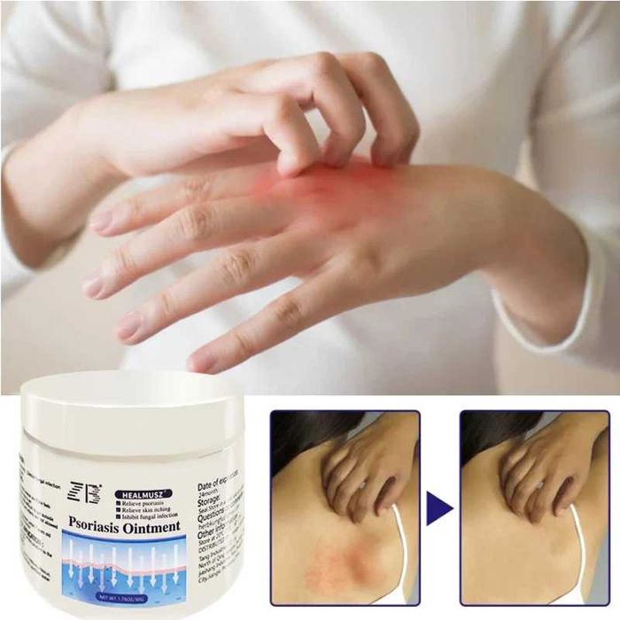 ZB Healmusz*2 bucati-Crema psoriazis, dermatita, prurit, antibacterian