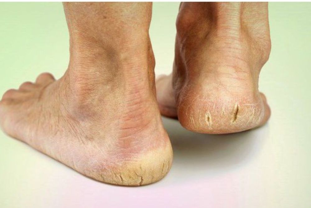 Квалифицированная помощь подолога.