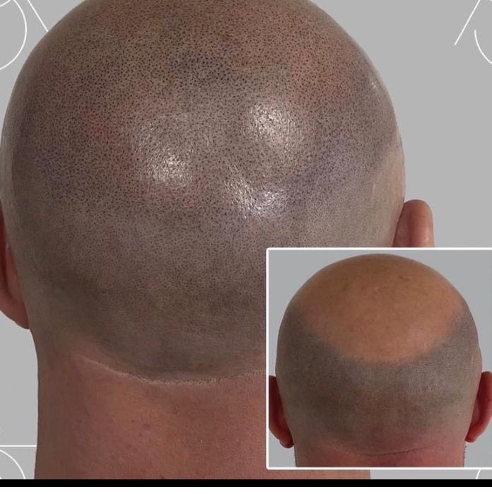 Micropigmentare scalp tricopigmentare efect indesire par alopecie SMP