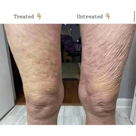 Ageloc Dermatic Effects - crema impotriva celulitei si a vergeturilor